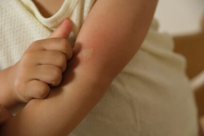 子どもの虫刺されが大きく腫れやすい理由